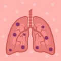 The NHS Approach to Pulmonary Rehabilitation: Funding, Delivery, and Access
